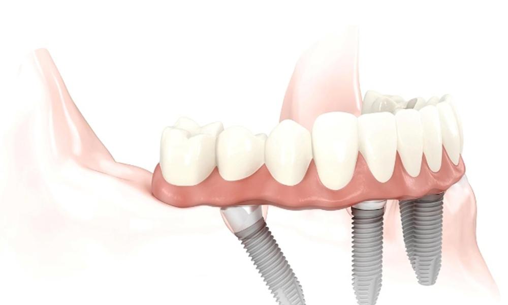Riabilitazione protesica totale su 4 impianti (tecnica ALL ON 4).