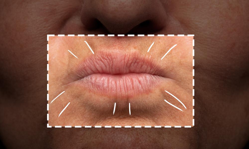 Trattamento rughe del codice a barre Padova