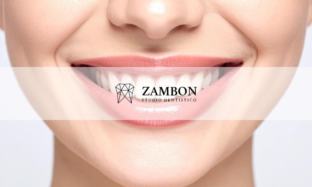 sbiancamento dentale Padova