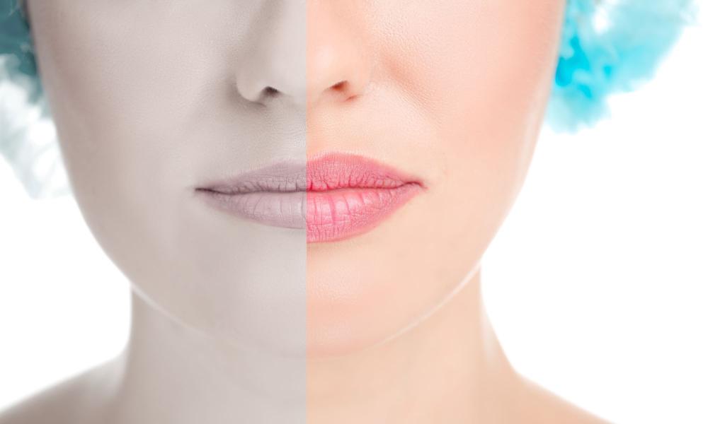 Trattamento Filler Labbra Padova