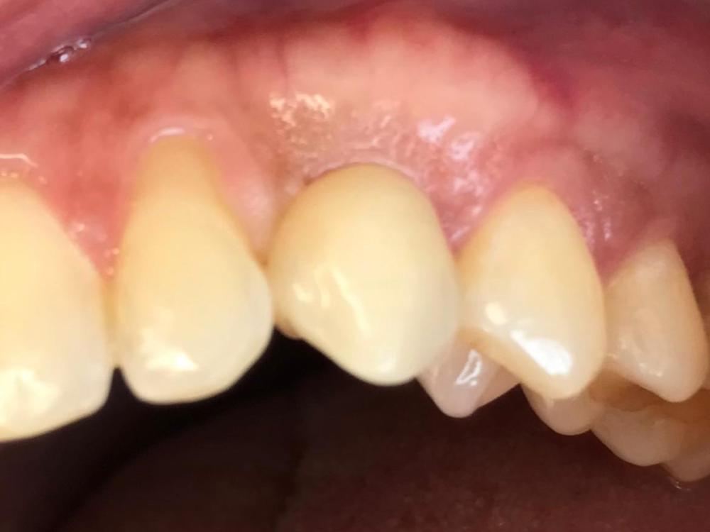 IMPIANTI DENTALI ANGOLATI PADOVA