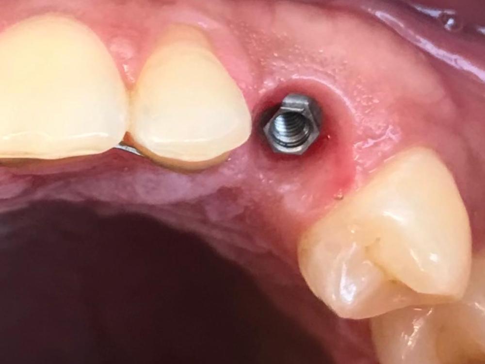 IMPIANTI DENTALI ANGOLATI PADOVA