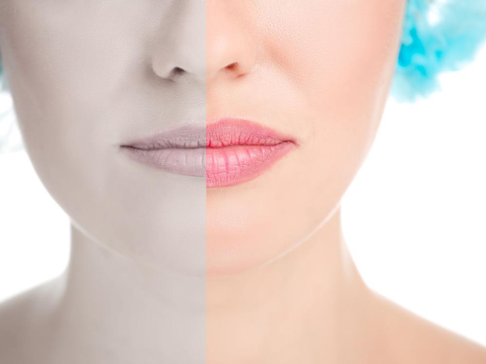 Trattamento Filler Labbra Padova
