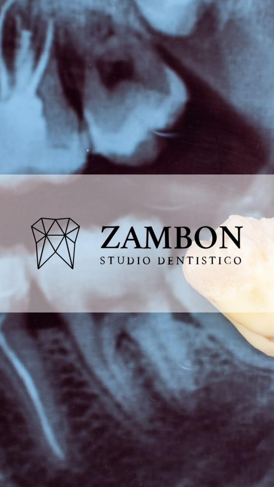 Rimozione dente giudizio Padova